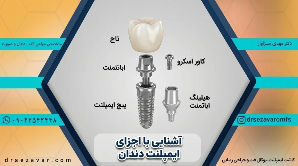 اجزای ایمپلنت دندان