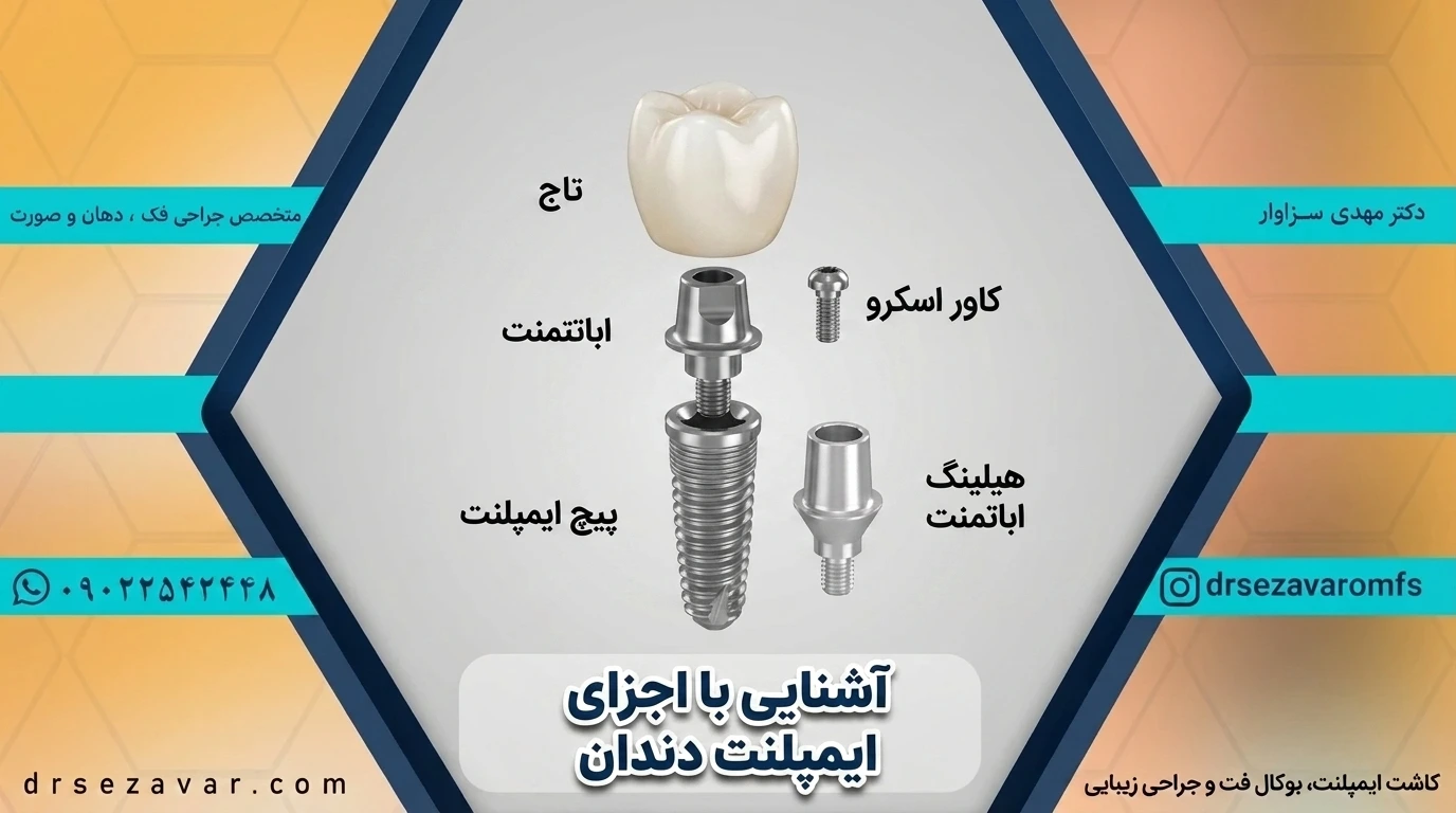 اجزای ایمپلنت دندان