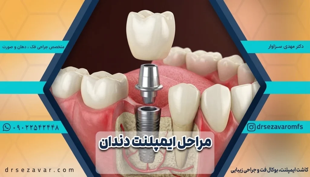 سه مرحله اصلی کاشت ایمپلنت شامل کاشت پایه، قالب گیری و نصب روکش است.