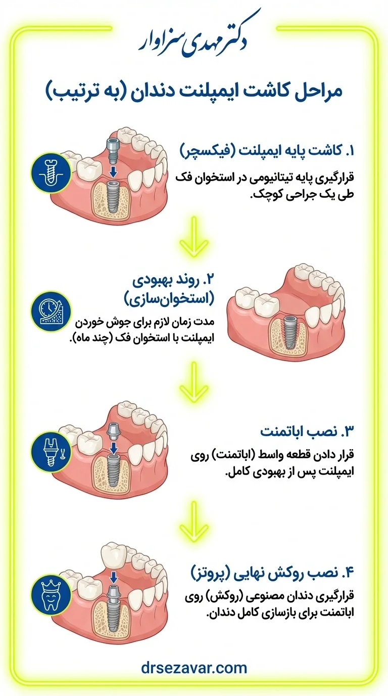 اصلی ترین مراحل ایمپلنت دندان شامل: کاشت پیچ، جوش خوردن پایه و استخوان، نصب اباتمنت و روکش است.