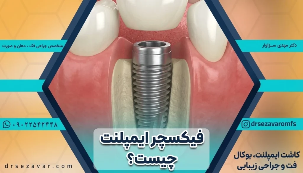 فیکسچر ایمپلنت