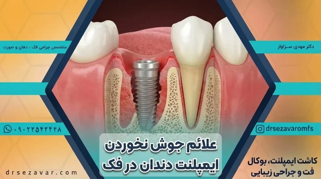 جوش نخوردن ایمپلنت دندان در استخوان فک و لثه