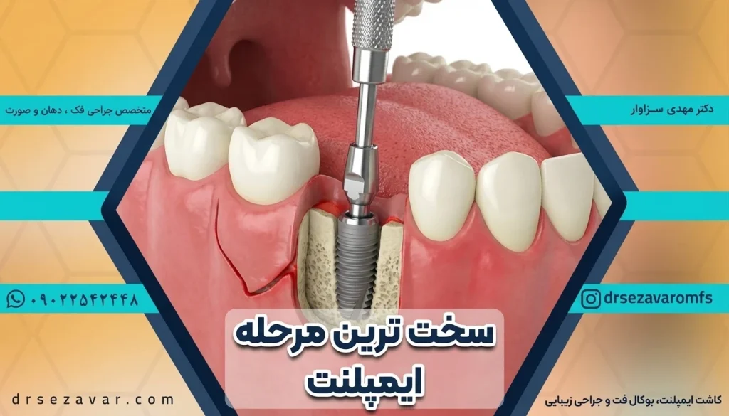 وارد شدن فیکسچر به استخوان فک، به عنوان سختترین مرحله ایمپلنت شناخته می شود.