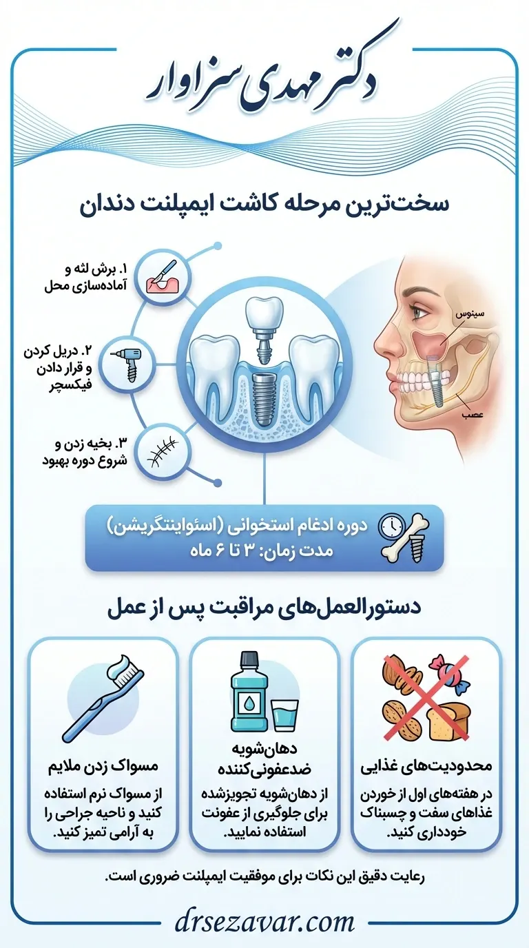آشنایی با کاشت فیکسچر ایمپلنت و نکات مراقبتی برای کاهش درد