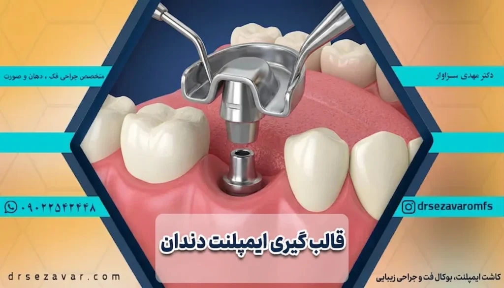 قالب گیری ایمپلنت دندان