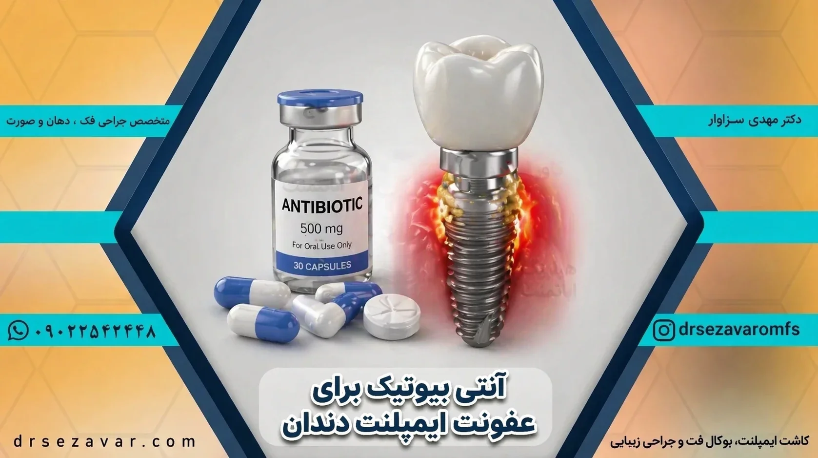 بهترین آنتی بیوتیک برای عفونت ایمپلنت