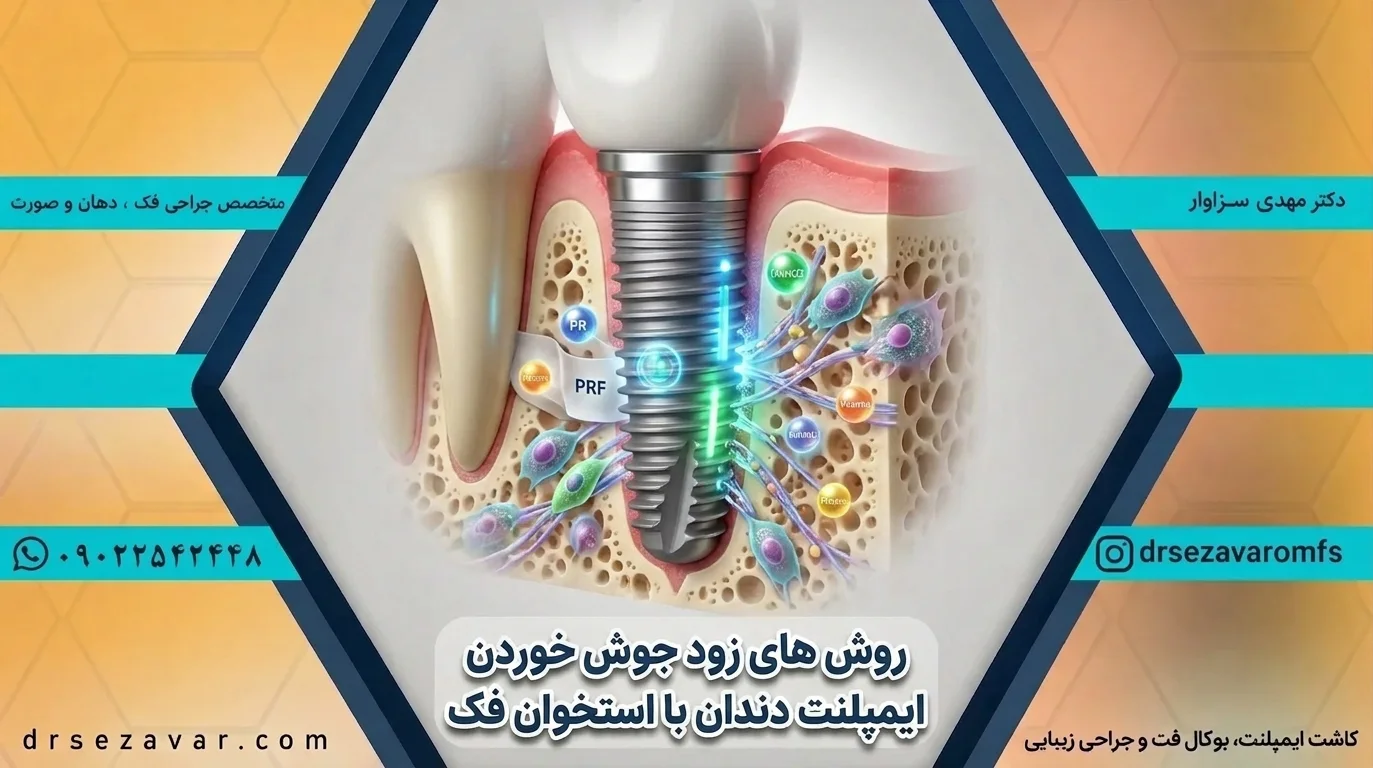زود جوش خوردن ایمپلنت با PRF