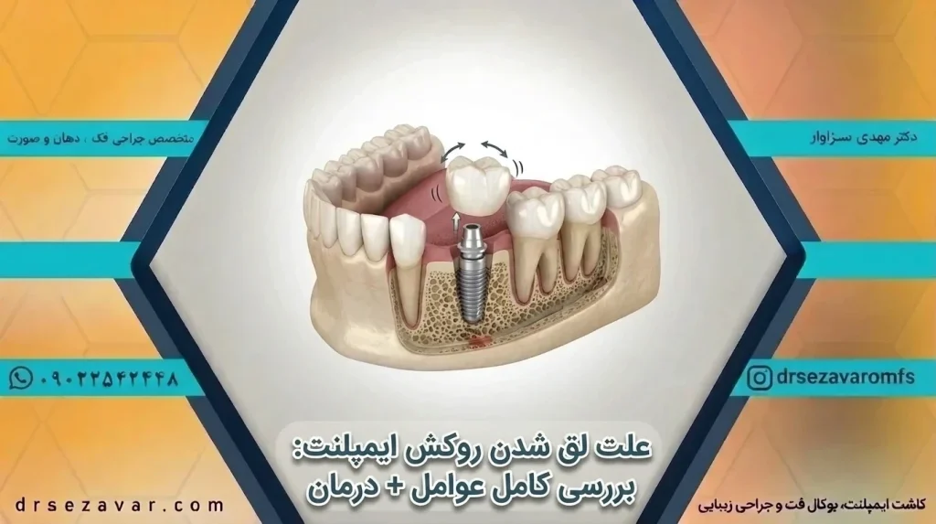 علت لق شدن روکش ایمپلنت