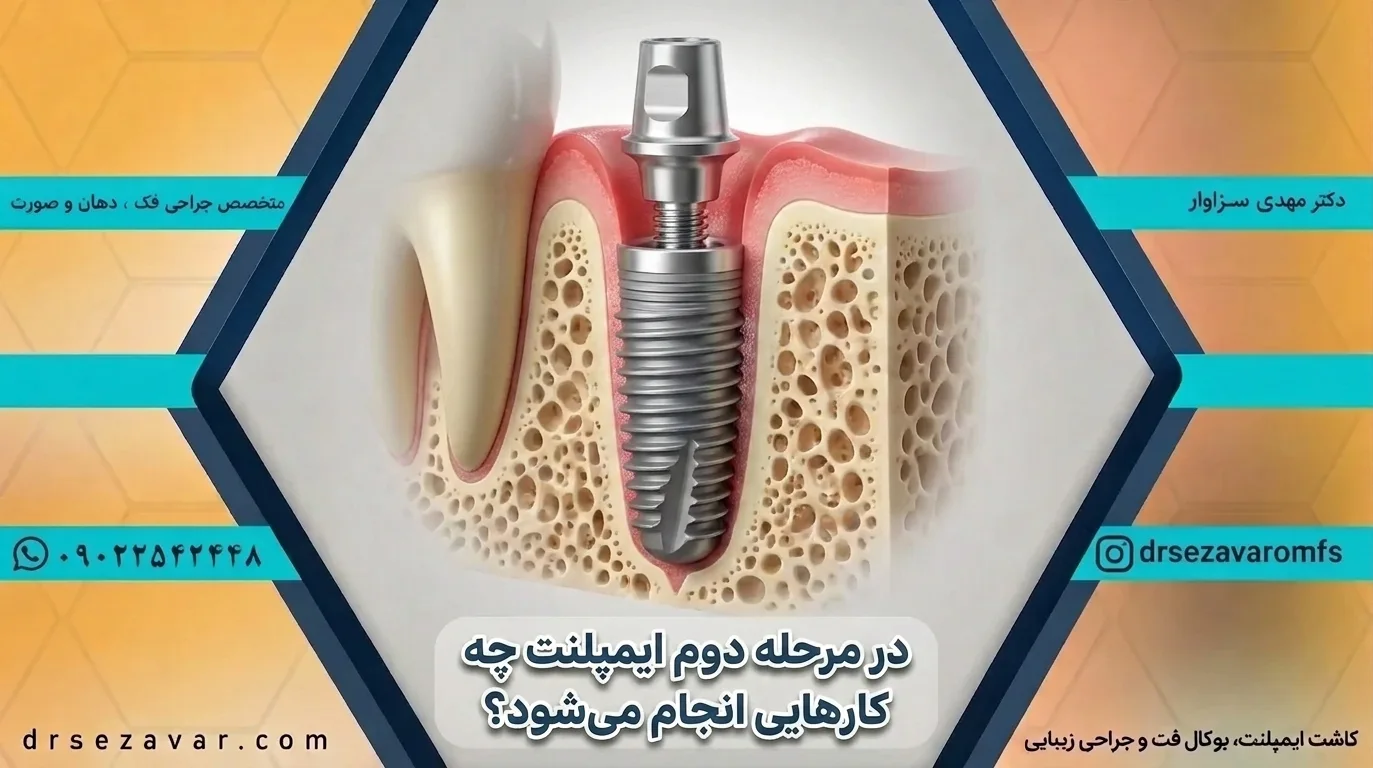 نصب هلینیگ روی فیسکچر در مرحله دوم ایمپلنت دندان