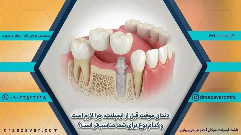 قرارگیری دندان موقت قبل از ایمپلنت روی پایه ایمپلنت