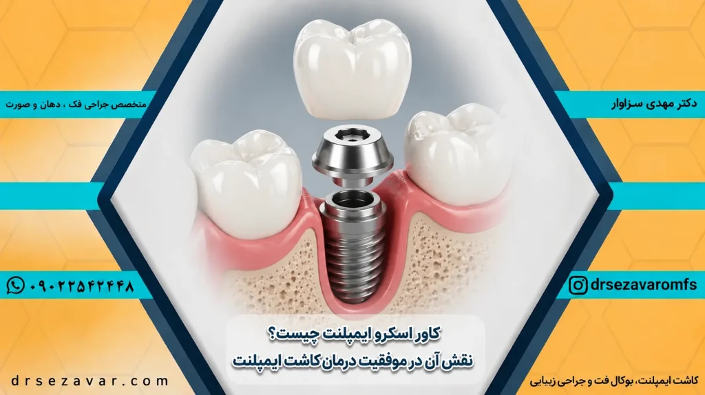 نمای کاور اسکرو ایمپلنت